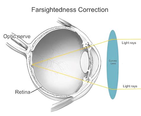 Can farsightedness get worse with glasses?