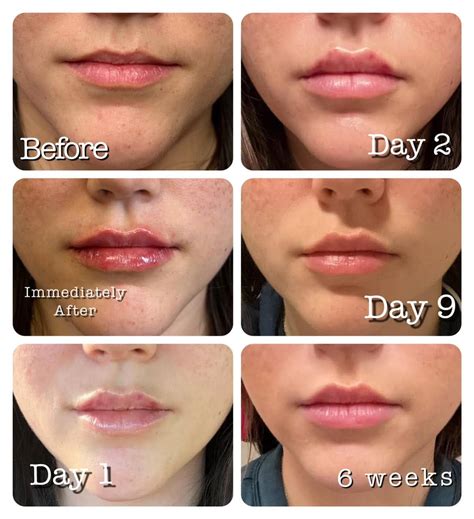 Can fillers move after 5 days?