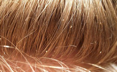 Can fleas lay eggs in your hair?
