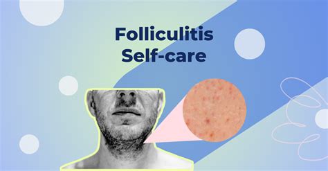 Can folliculitis self resolve?
