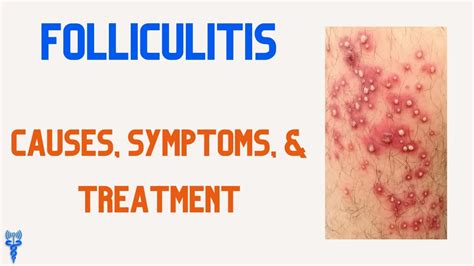 Can folliculitis spread to others?