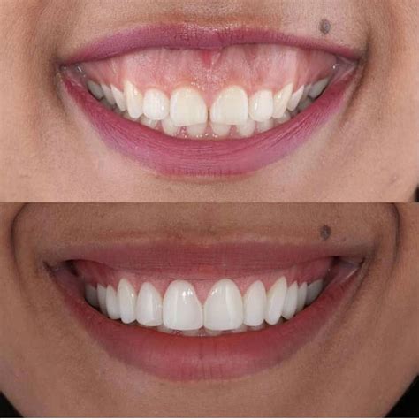 Can frenectomy fix gummy smile?