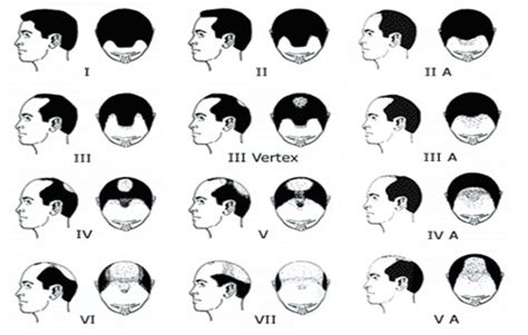 Can genetic balding be stopped?