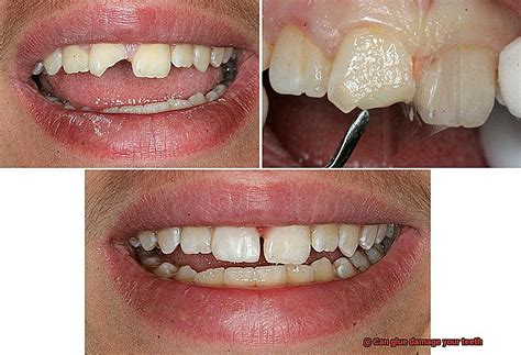 Can glue damage your teeth?