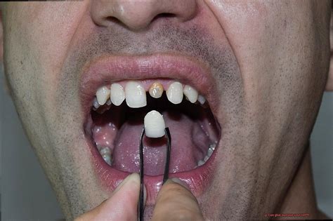 Can glue damage your teeth?