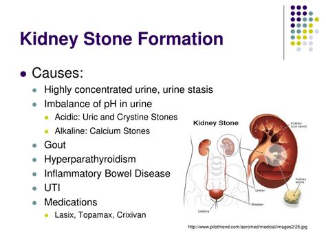 Can glutathione cause kidney stones?