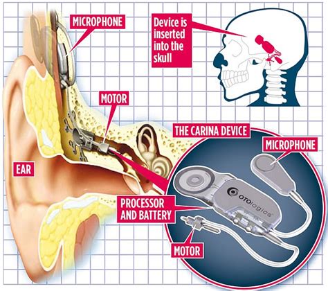 Can going deaf be cured?