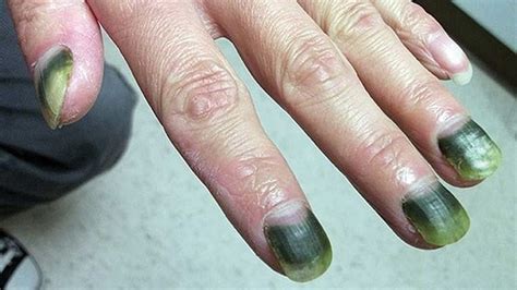 Can green nails grow out?
