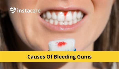 Can gum bleeding be cured?