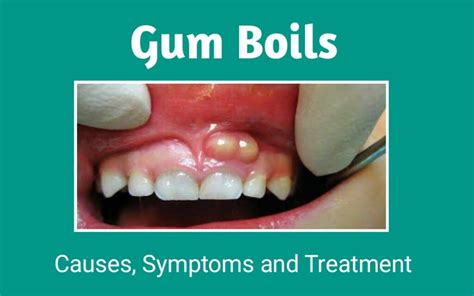 Can gum boils be hard?