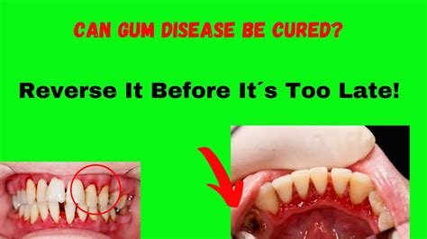 Can gum disease be cured by brushing?
