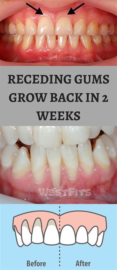 Can gum pockets grow back?