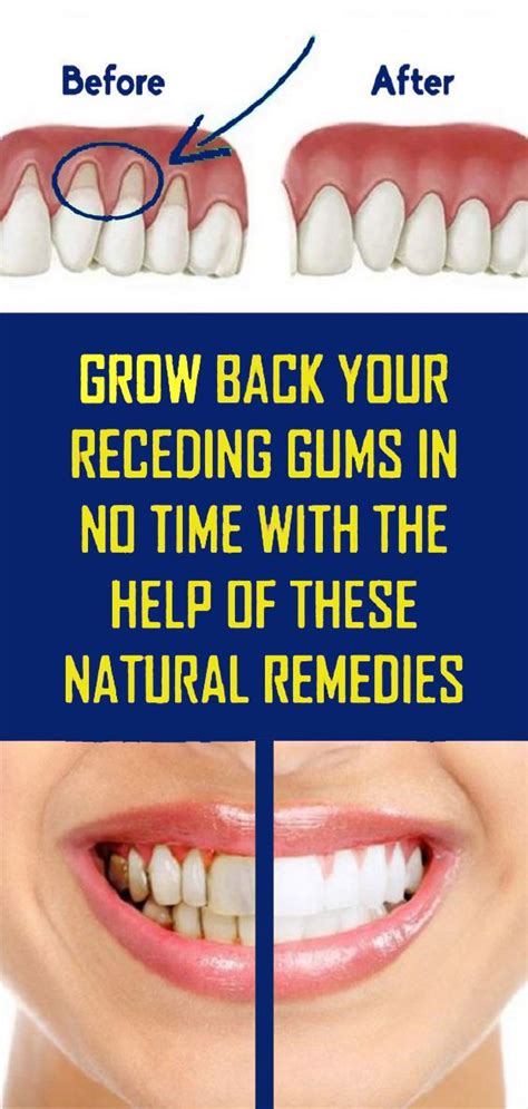 Can gums grow back naturally?