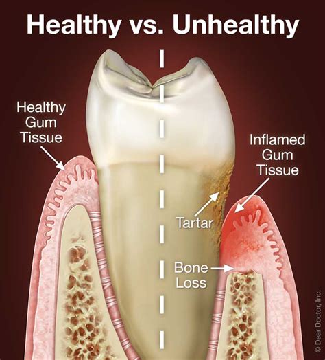 Can gums heal from periodontitis?