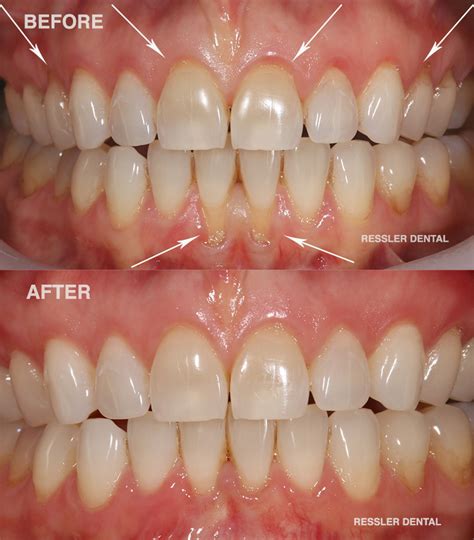 Can gums recede after cleaning?