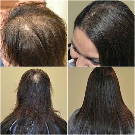 Can hair extensions fix thinning hair?
