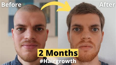 Can hair grow 2 cm a month?