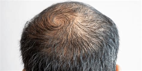 Can hair grow back after thinning?