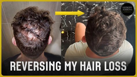 Can hair loss reversed?