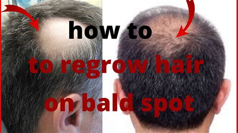 Can hair regrow in bald spots?
