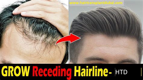 Can hairline grow back?