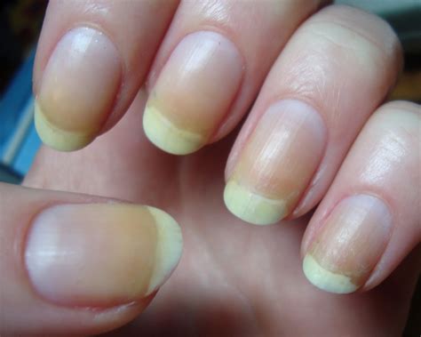 Can healthy nails be yellow?