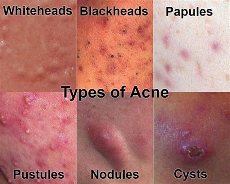 Can heat cause cystic acne?