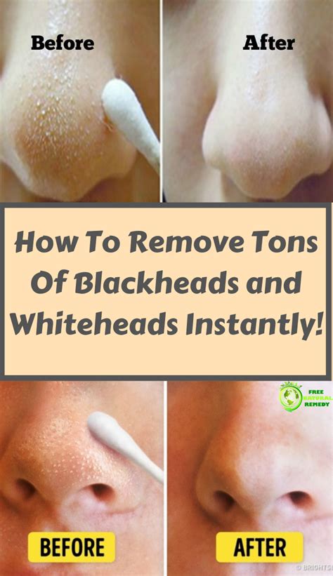 Can hot water remove blackheads?