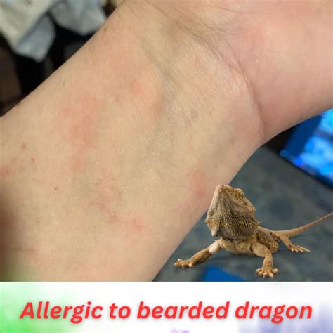 Can humans be allergic to bearded dragons?