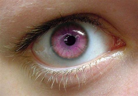 Can humans have naturally pink eyes?