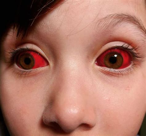 Can humans have red eyes?