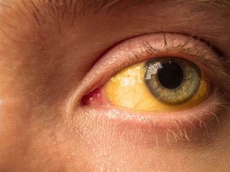 Can humans have yellow eyes?