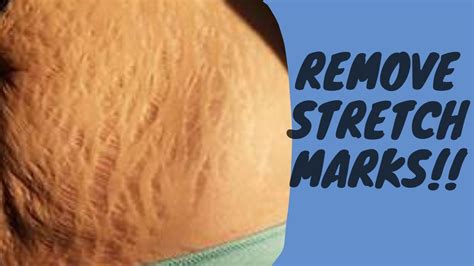 Can ice remove stretch marks?
