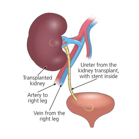 Can kidneys be transplanted?