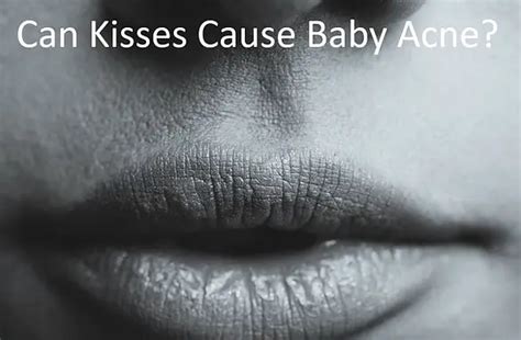 Can kisses cause pimples?