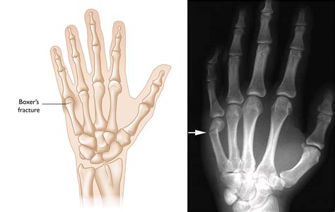 Can knuckles break bones?