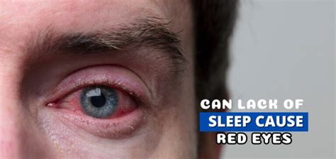 Can lack of sleep cause eye dilation?