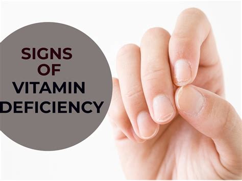 Can lack of vitamin D affect nails?