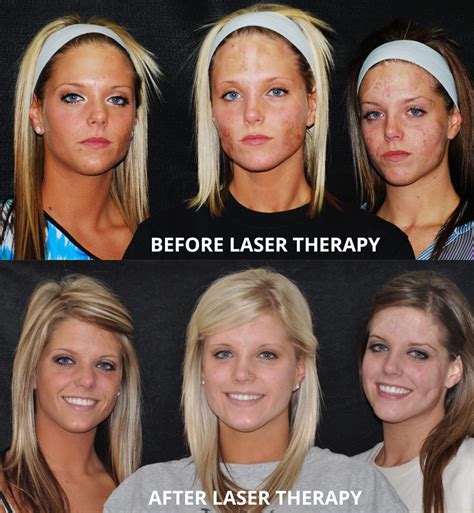 Can laser remove burn scars?