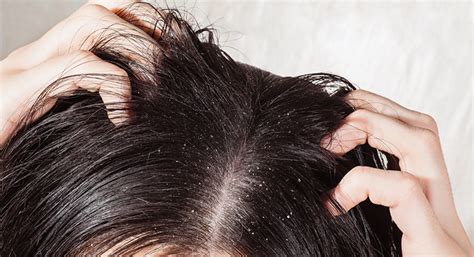 Can leaving hair wet cause fungus?