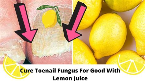 Can lemon cure fungi?