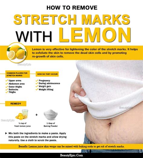 Can lemon remove stretch marks?