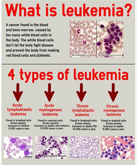 Can leukemia be genetic?