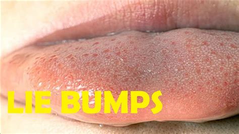 Can lie bumps spread?