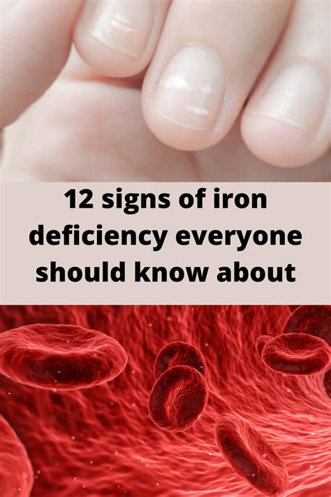 Can low iron make your skin purple?