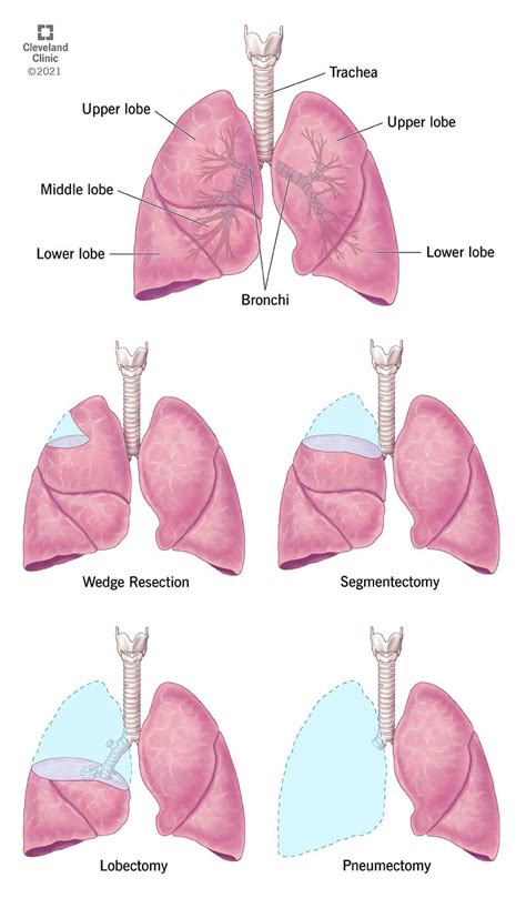 Can lung function be restored?