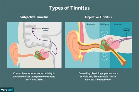 Can magnets cause tinnitus?