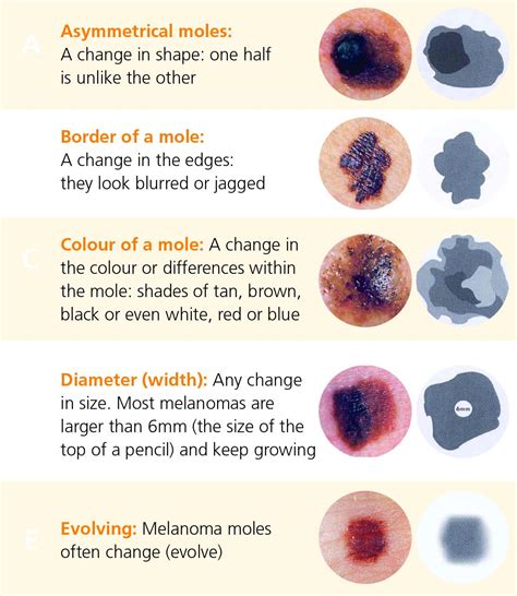 Can melanoma be blue?