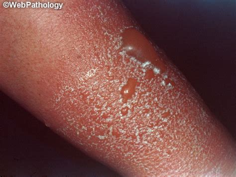 Can mercury cause dermatitis?