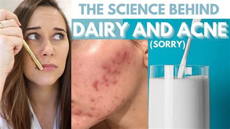 Can milk cause acne?